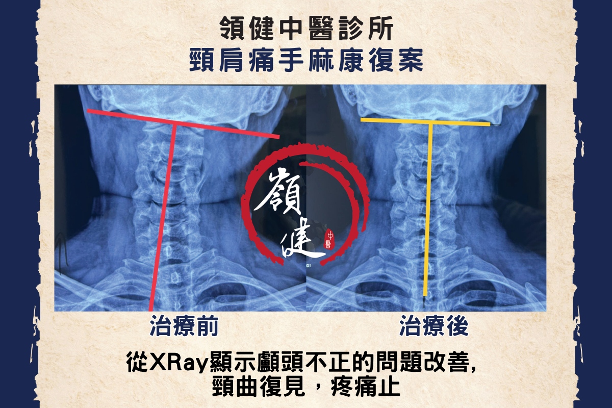 頸肩痛手麻康復案
