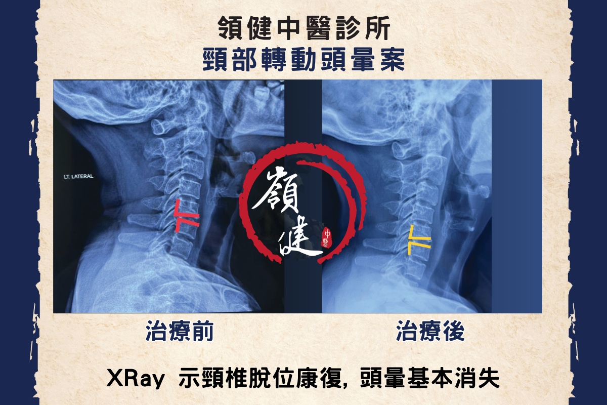 頸部轉動頭暈案