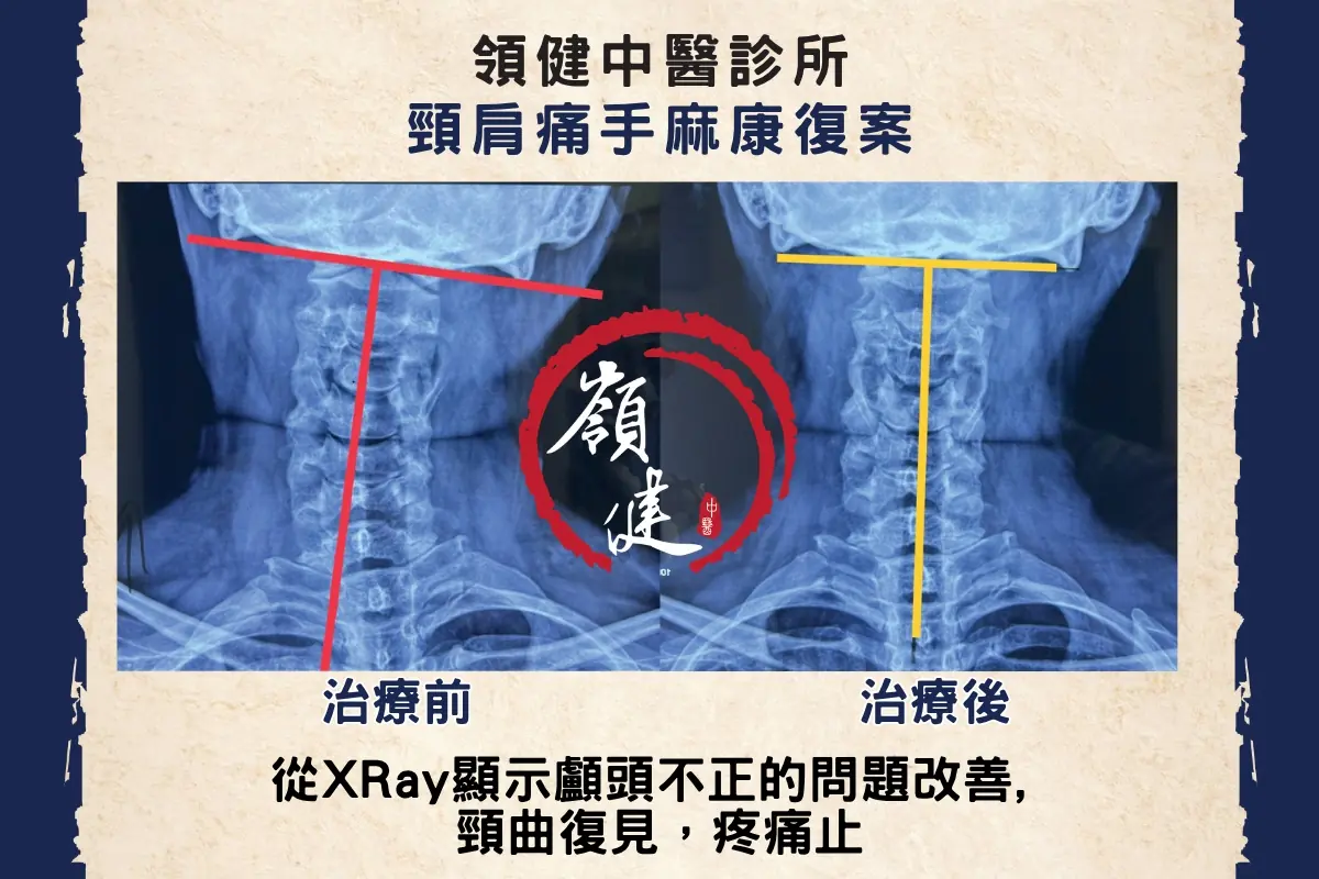 頸肩痛手麻康復案